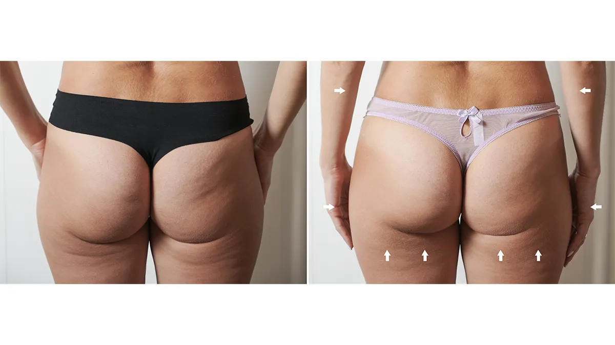 FAQ 411 before and after how to get rid of cellulite on thighs and bum